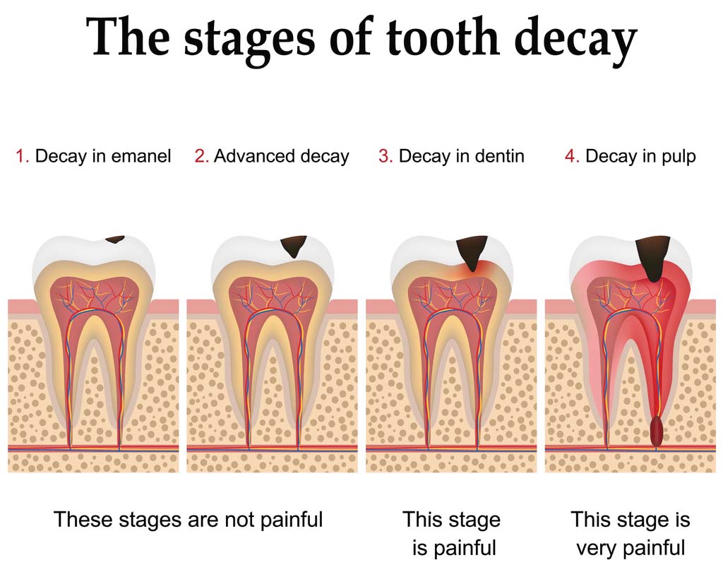 Stage-of-Tooth-Decay